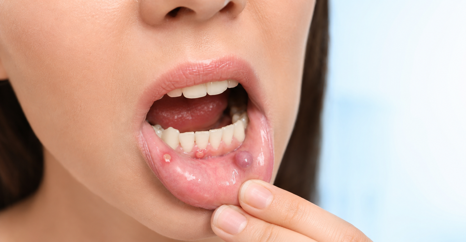 Can You Get Zits Inside Your Mouth